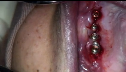 DM_il dentista moderno_Perimplantite approccio chirurgico e protesico