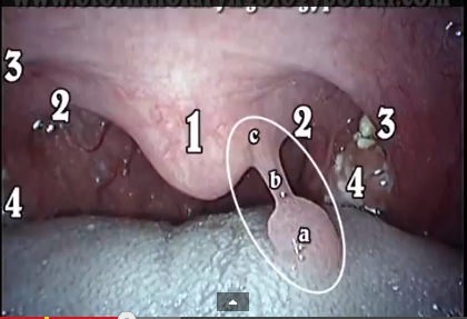 papilloma interno bocca