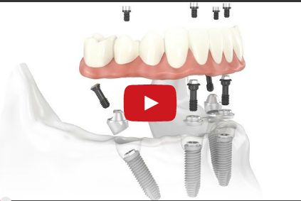 DM_il dentista moderno_inserimento implantare_osso _carico