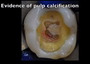 DM_il dentista moderno_pulpoliti_endodonzia