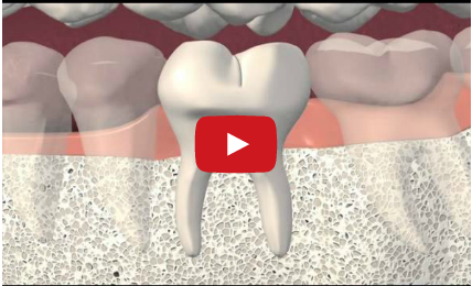 DM_il dentista moderno_frattura verticale elemento dentario