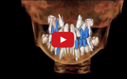DM_Il dentista moderno_pianificazione ortodontica