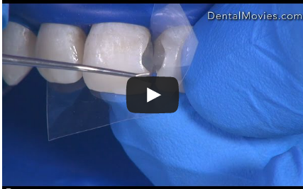 DM_il dentista moderno_odontoiatria restaurativa conservativa_fattore c stress contrazione