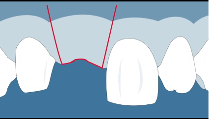 DM_il dentista moderno_parodontologia roll flap