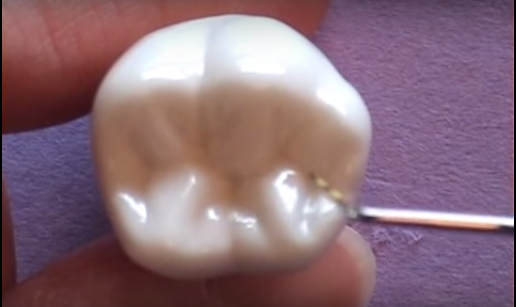 dm_il-dentista-moderno_anatomia-molari-mandibolari
