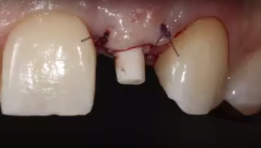 DM_il dentista moderno_restauri metal-free