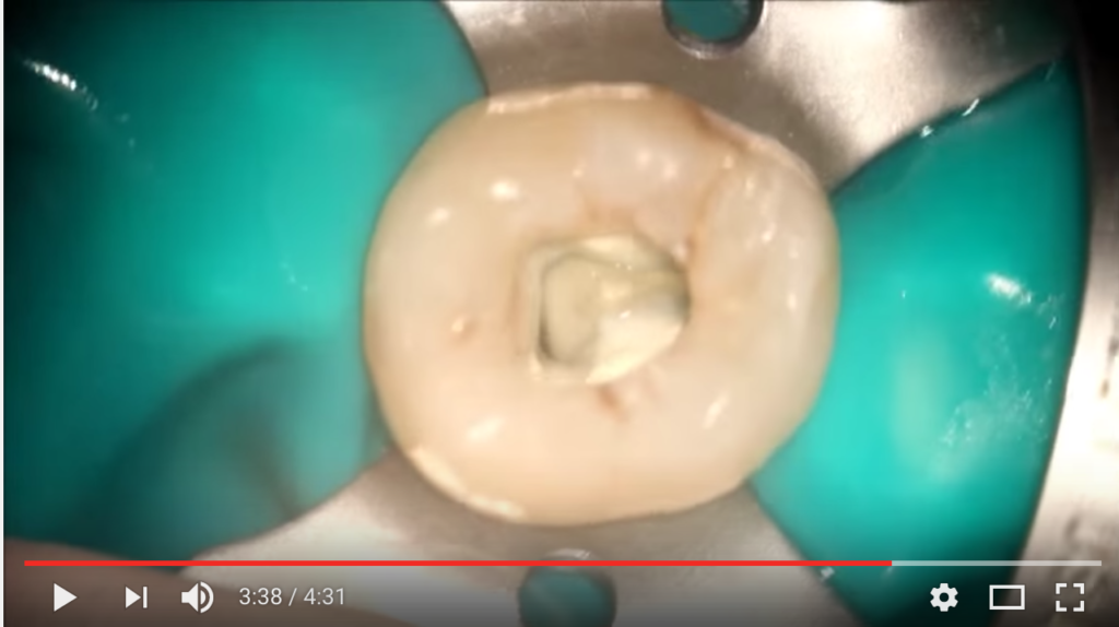 dm_il-dentista-moderno_anatomia-canalare-molari-inferiori