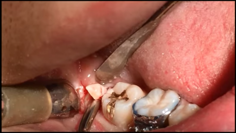 dm_il-dentista-moderno_corticotomio-terzi-molari-inferiori