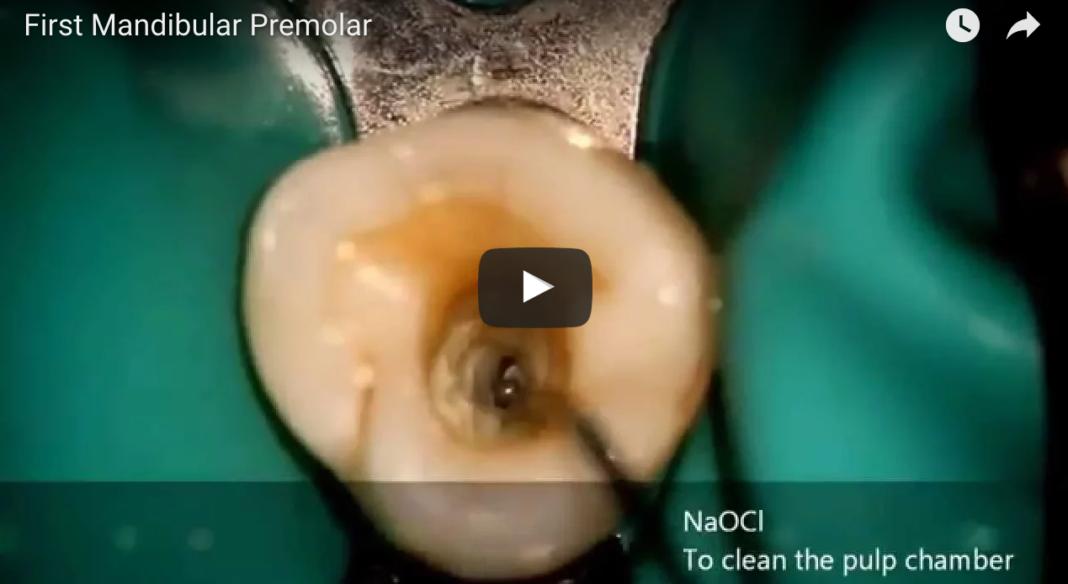 Il dentista moderno_anatomia canalare premolari mandibolari