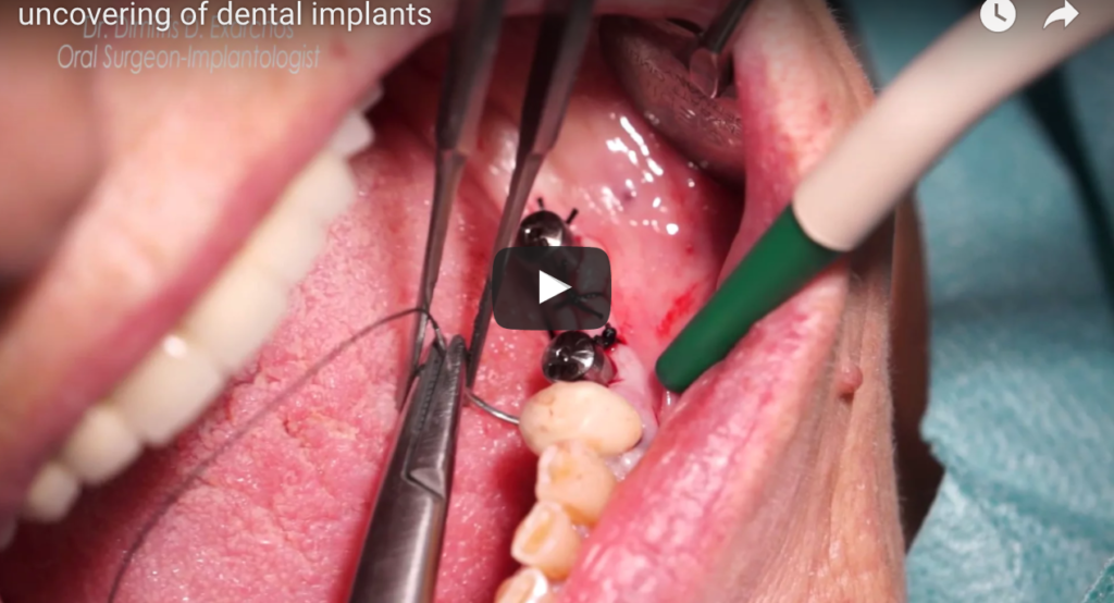 DM_il dentista moderno_Tecniche di riapertura implantare