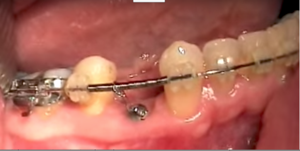 DM_il dentista moderno_anchilosi dentale