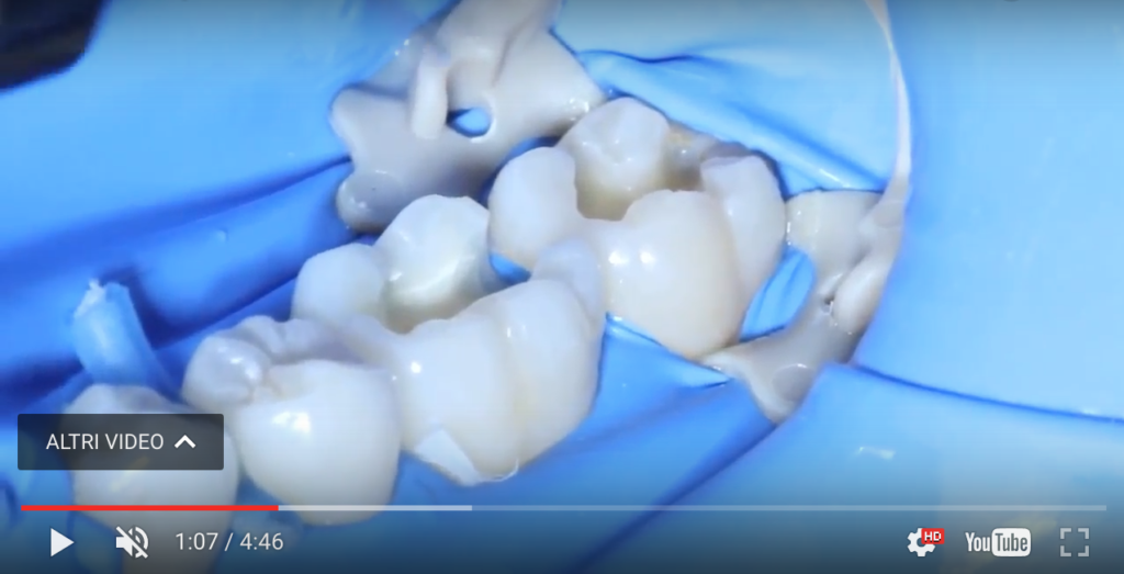 DM_il dentista moderno_resine composite_compositi in odontoiatria