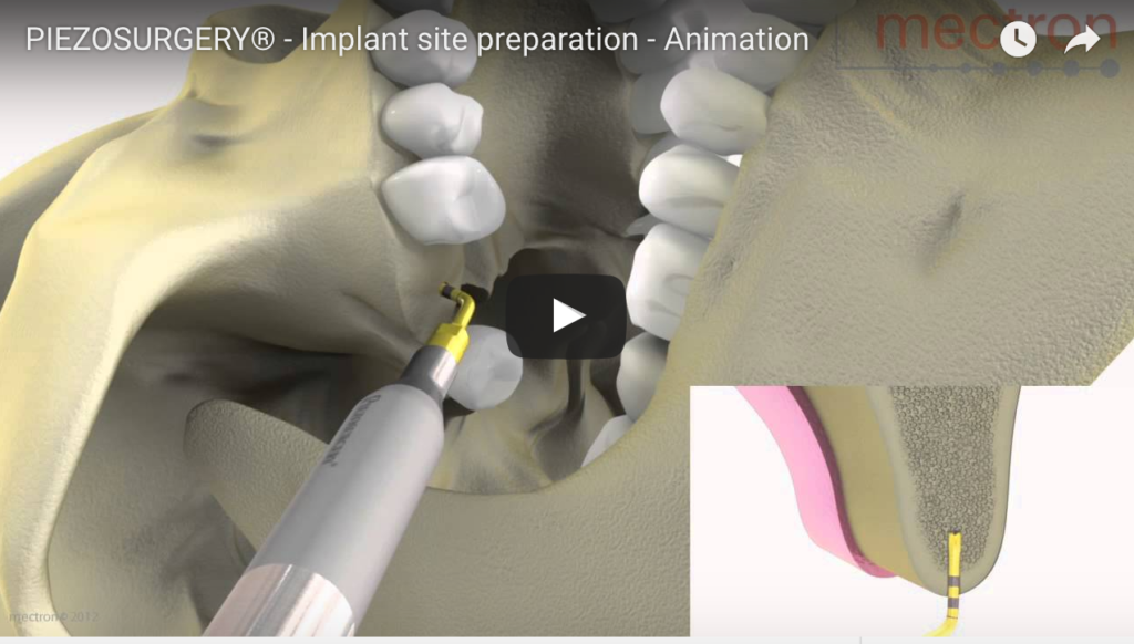 DM_il dentista moderno_L'utilizzo degli strumenti piezoelettrici nell'allestimento del sito implantare