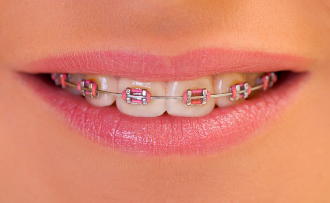 DM_il dentista moderno_parodonto_bracket_ortodonzia_legamento parodontale_Short term orthodontics_ortodonzia_incisivo centrale