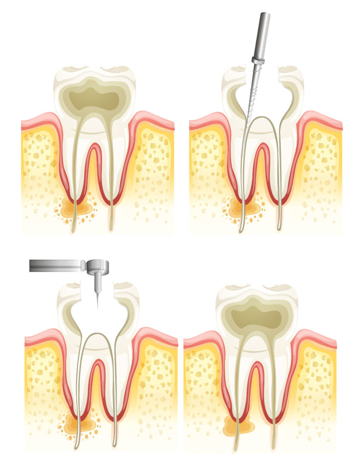DM_il dentista moderno_ pervietà degli orifizi durante il build-up pre-endodontico