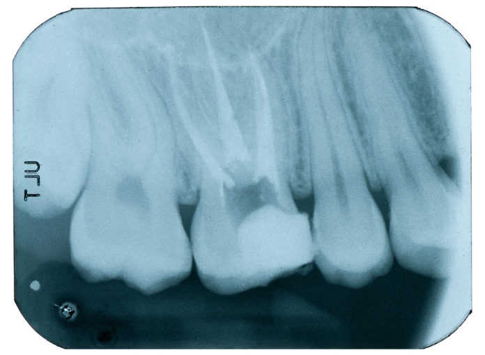 DM_il dentista moderno_errori in endodonzia_devitalizzazione