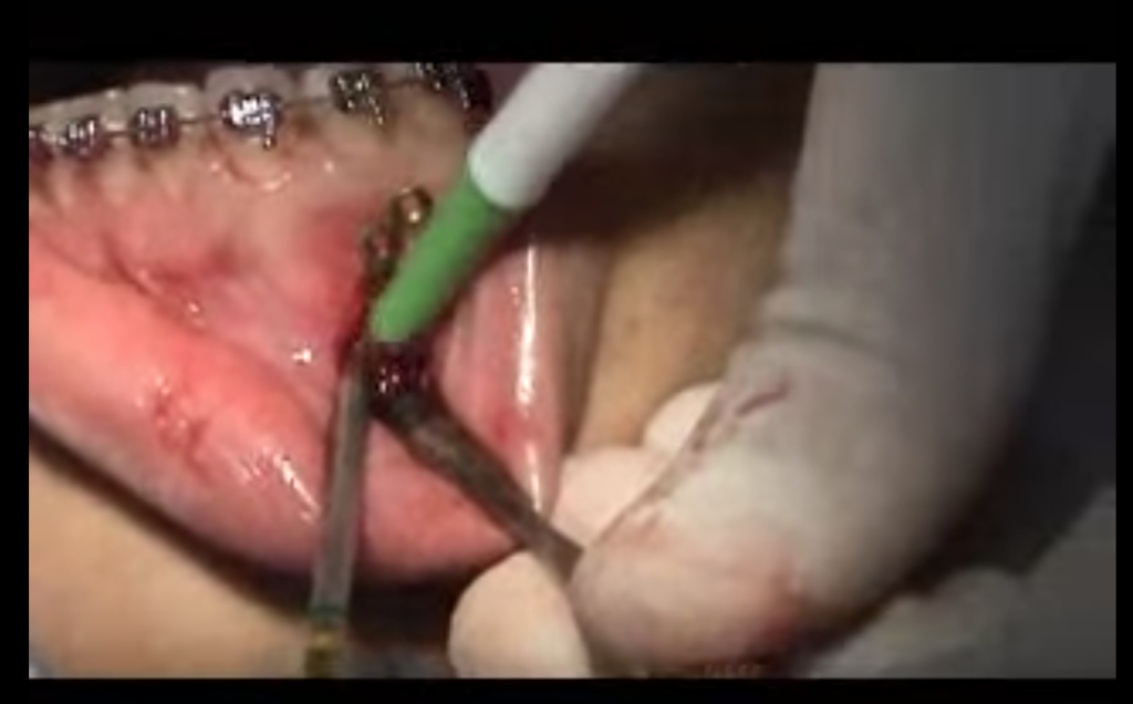 DM_il dentista moderno_Placche ortodontiche di ancoraggio infezione e fattori predittivi
