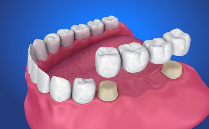DM_il dentista moderno_Fatigue test applicato ai materiali ceramici