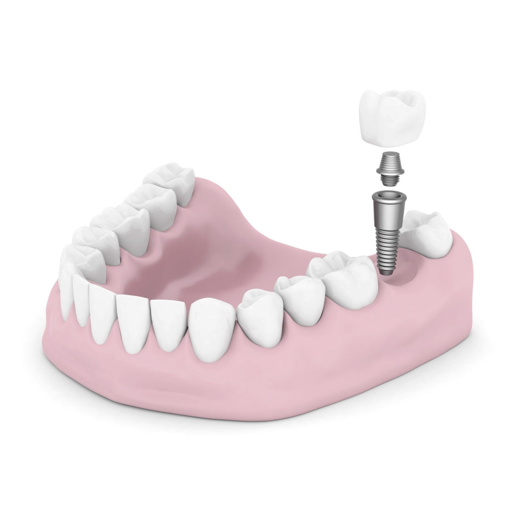 DM_il dentista moderno_Rischio implantare nel paziente con patologie sistemiche