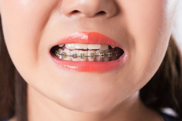 DM_il dentista moderno_vite ortodontica_mini vite_ramo mandibolare_trattamento ortodontico
