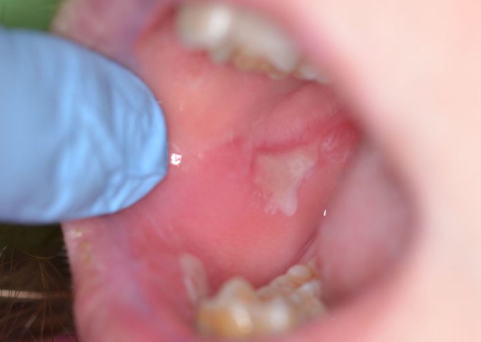 ulcere orali in pazienti affetti da epidermolisi bollosa