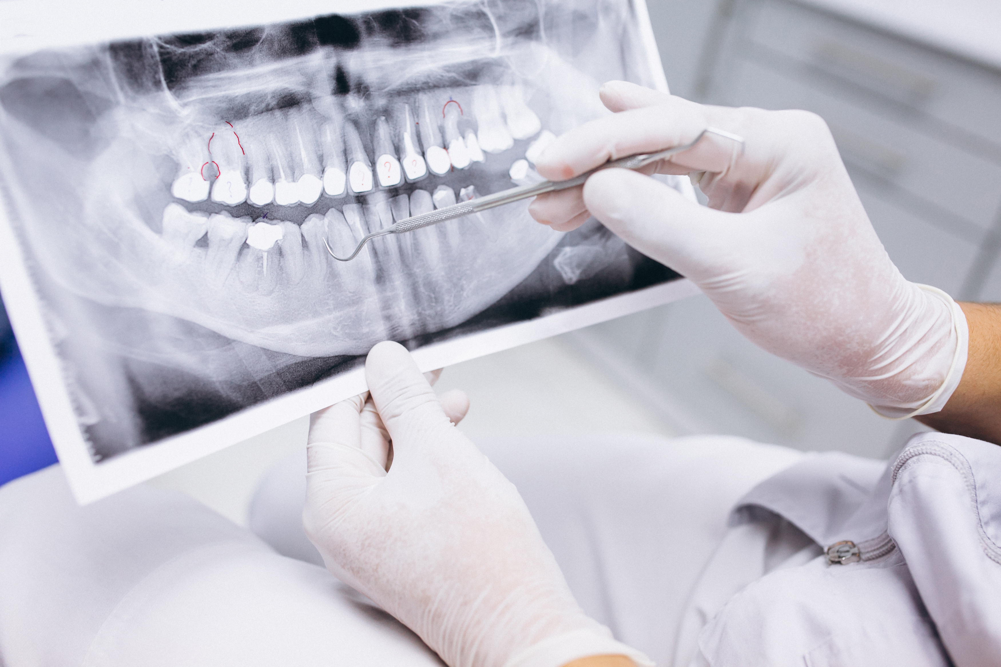 Dm_il-dentista-moderno_diagnosi-in-parodontologia._difetti infraossei