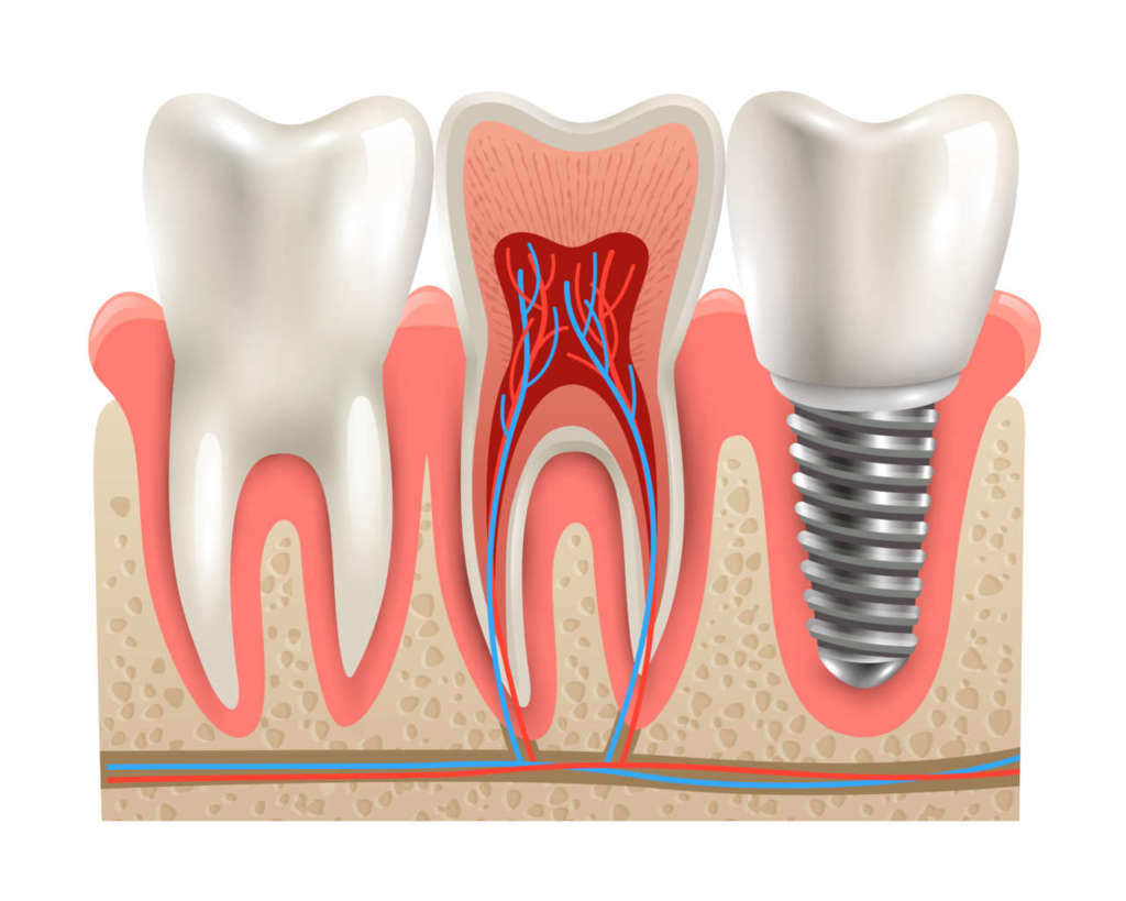 DM_il-dentista-moderno_Efficacia-ai-lungo-termini-di-un-protocollo-di-implantologia-immediata.jpg
