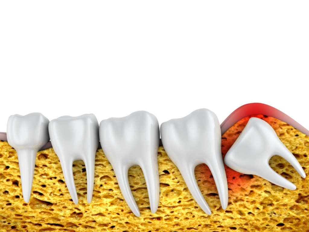 DM_il-dentista-moderno_terzo-molare_dente-del-giudizio_terzo molare