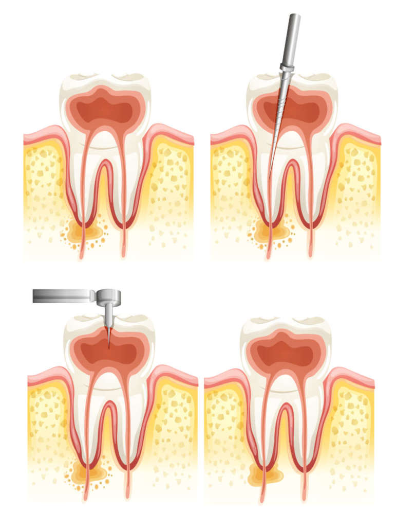 DM_il-dentoista-moderno_endodonzia_terapia-canalare_ecpgrafia in endodonzia