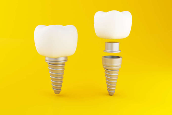 DM_il-dentista-moderno_Possibile-vantaggio-dell’uso-di-abutment-in-zirconia-riduzione-della-perdita-di-osso-crestale.