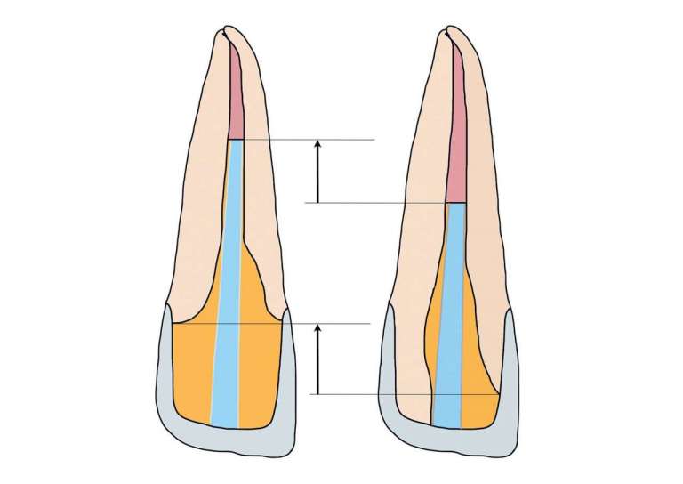 Adesione a livello coronale di perni in composito rinforzato con fibra di vetro