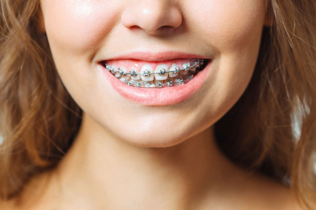 DM_il-dentista-moderno_momento-auxologico-in-ortodonzia.jpg_ancoraggio ortodoontico