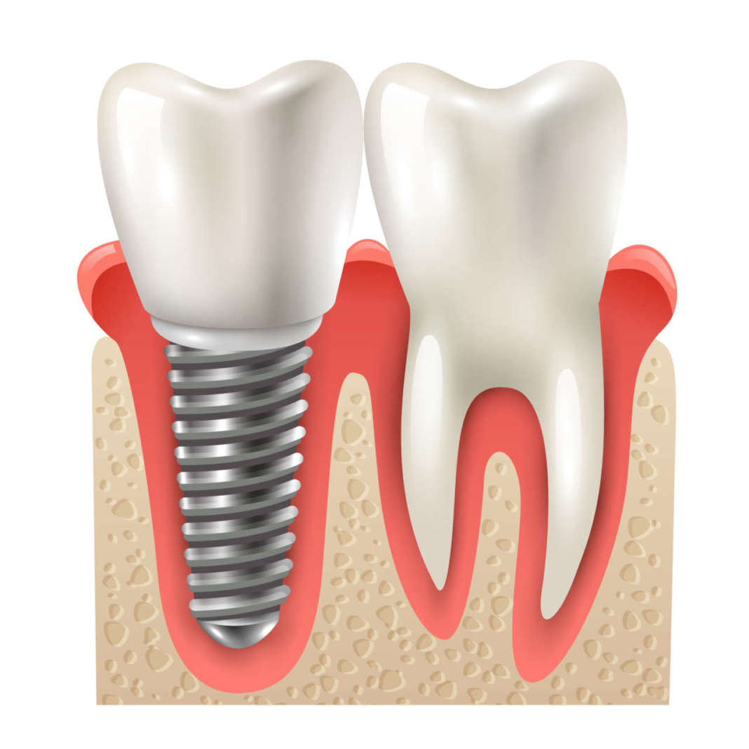 dm_il-dentista-moderni_implantologia immediata