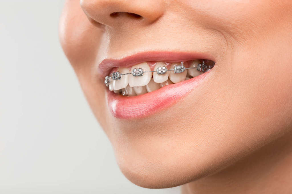 Durata Trattamento ortodontico nell'adulto