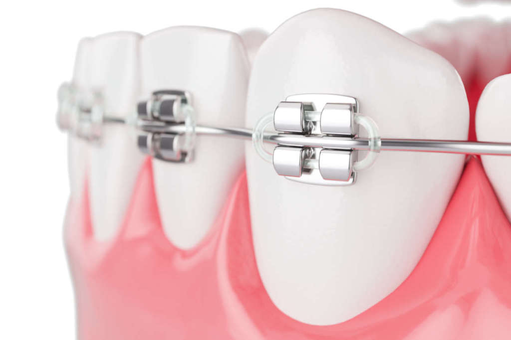 DM_il-dentista-moderno_forze-ortodontiche-ottimali.jpg