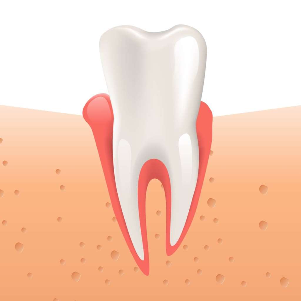 DM_il-dentista-iperplasia-gengivale