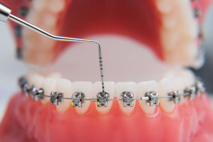 DM_il-dentista-moderno_Validità-clinica-e-di-laboratorio-degli-adesivi-ortodontici-monocomponente.