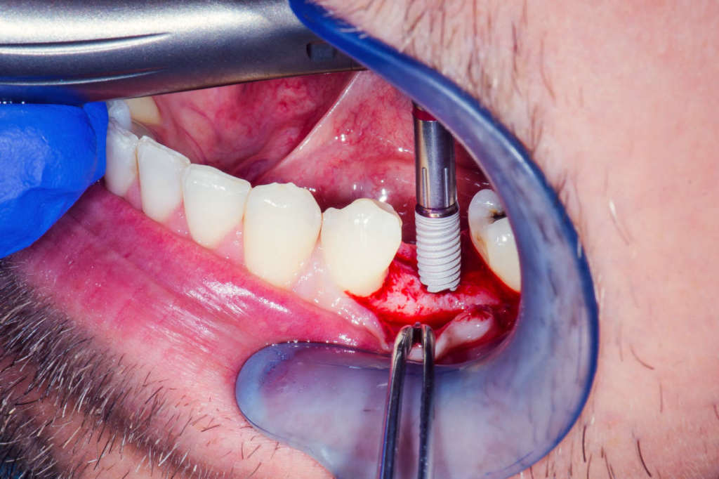 DM_il dentista moderno_chirurgia implantare_nervo alveolare inferiore