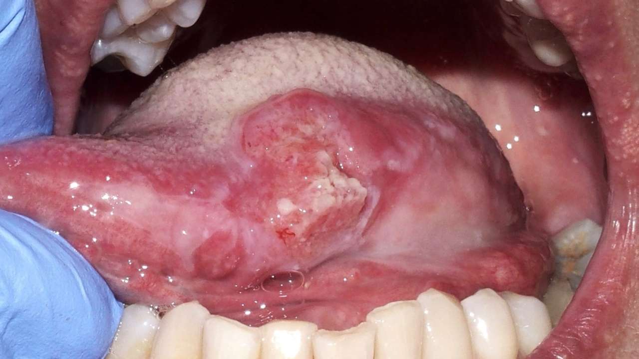 cancro orale