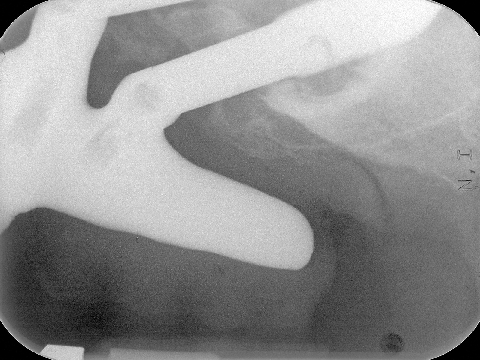 fig-20-radiografias-periapicais-da-malo-clinic-acrylic-bridge-superior-3