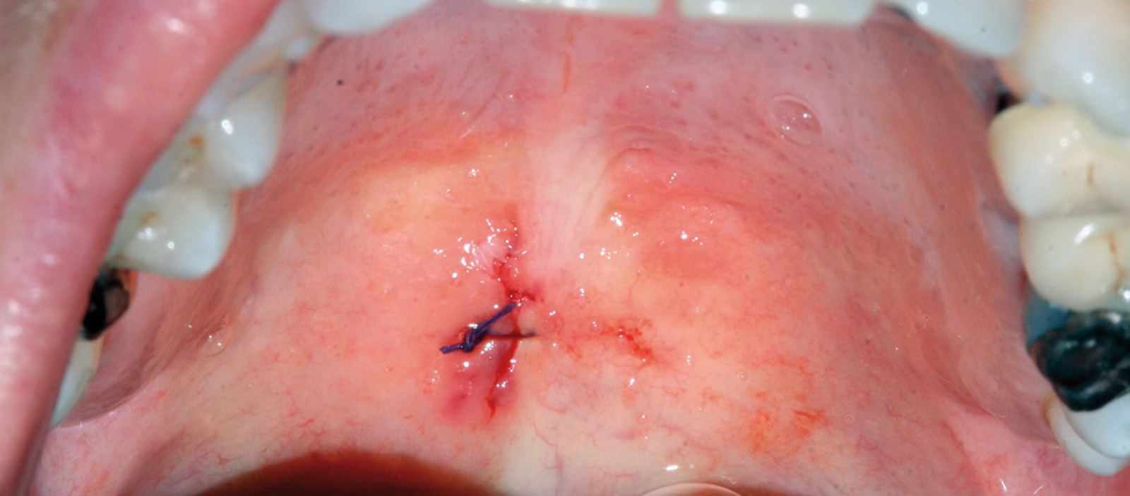 Rimozione papilloma bocca. Hpv tumore gola - alexandrudiaconescu.ro