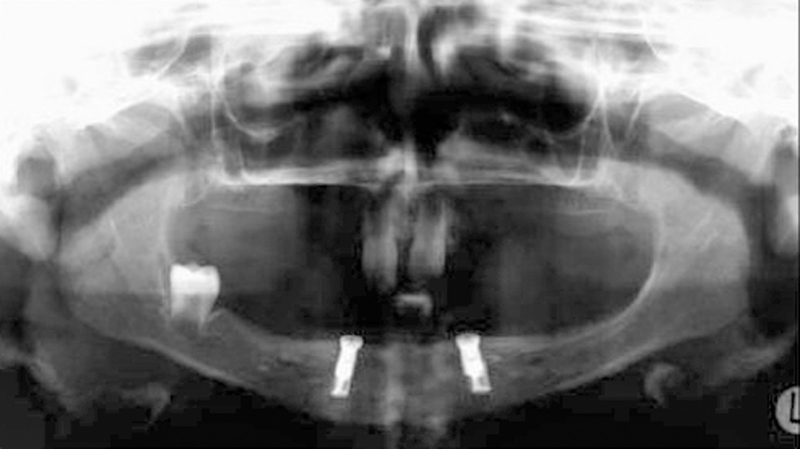 2. Ortopantomografia eseguita dopo l’inserimento degli impianti.  