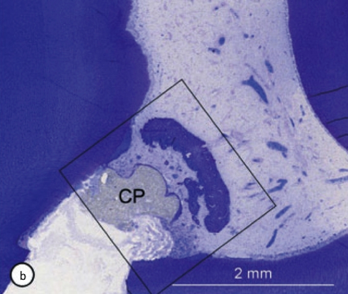 2. Dente incappucciato con Dycal, valutazione a 3 mesi. La macrofotografia (a) mostra il materiale da incappucciameto (CP). La microfotografia (b) del campione mostra la cavità pulpare che comunica con il difetto e dei residui di materiale da incappucciamento (CP).                 