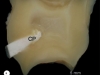 2. Dente incappucciato con Dycal, valutazione a 3 mesi. La macrofotografia (a) mostra il materiale da incappucciameto (CP). La microfotografia (b) del campione mostra la cavità pulpare che comunica con il difetto e dei residui di materiale da incappucciamento (CP).                 