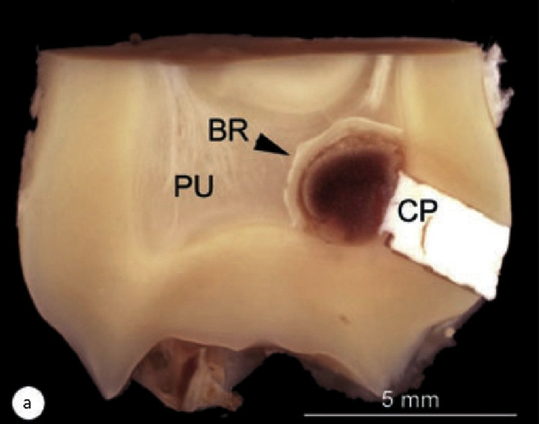 1. Dente incappucciato con MTA, valutazione a 3 mesi. La macrofotografia (a) mostra il materiale da incappucciamento (CP) e il ponte di dentina neoformato (BR) sulla polpa esposta (PU). La microfotografia (b) del campione mostra il ponte di dentina (BR) che si estende in modo continuo per tutta la larghezza del difetto.  