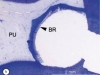 1. Dente incappucciato con MTA, valutazione a 3 mesi. La macrofotografia (a) mostra il materiale da incappucciamento (CP) e il ponte di dentina neoformato (BR) sulla polpa esposta (PU). La microfotografia (b) del campione mostra il ponte di dentina (BR) che si estende in modo continuo per tutta la larghezza del difetto.  